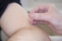 Acupuncture pain relief sports injury Sheffield